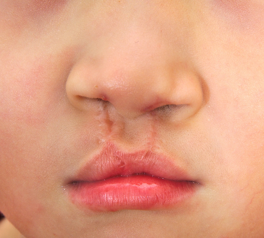 Cleft Lip and Palate