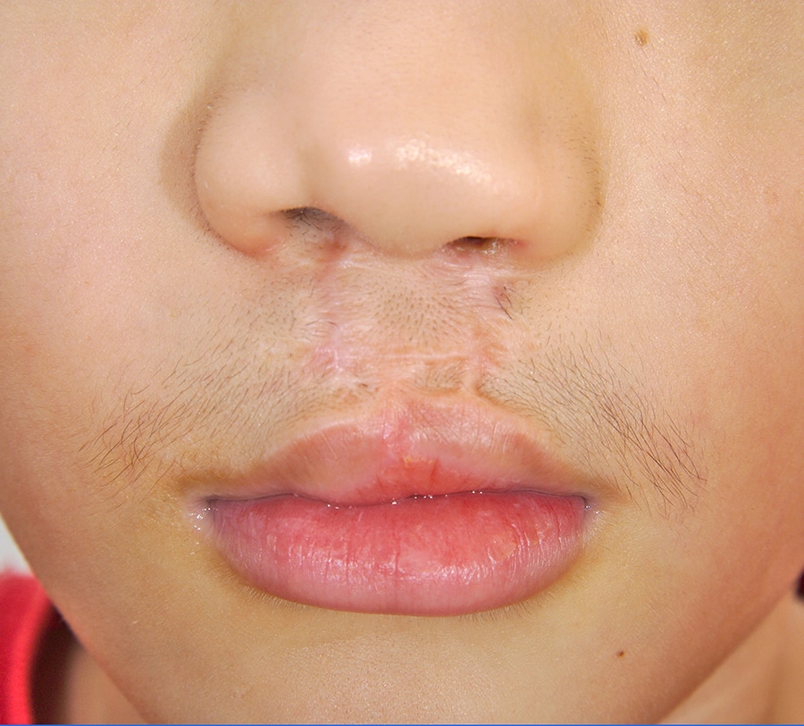 Cleft Lip and Palate