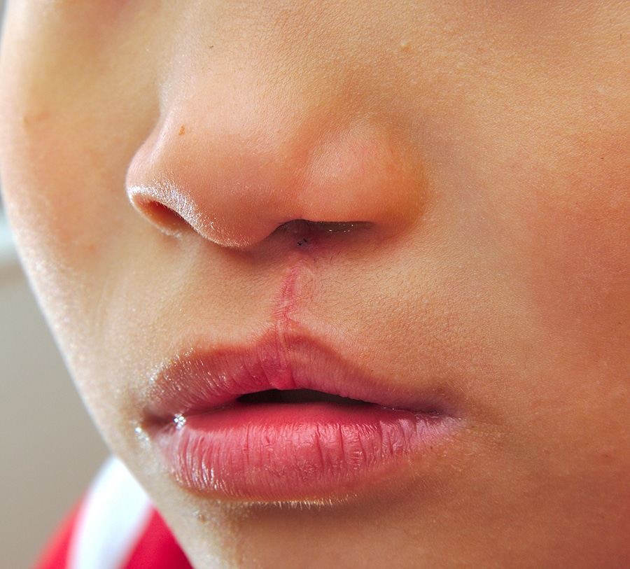 Cleft Lip and Palate